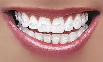 patient smiling with clear braces